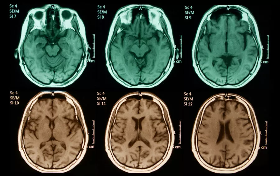 Brain similarity of orgasm during porn and a drug addict